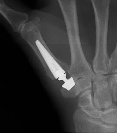 Radiographie d'implant médical dans un poignet - arthroplastie | Leman hand Clinic Genève