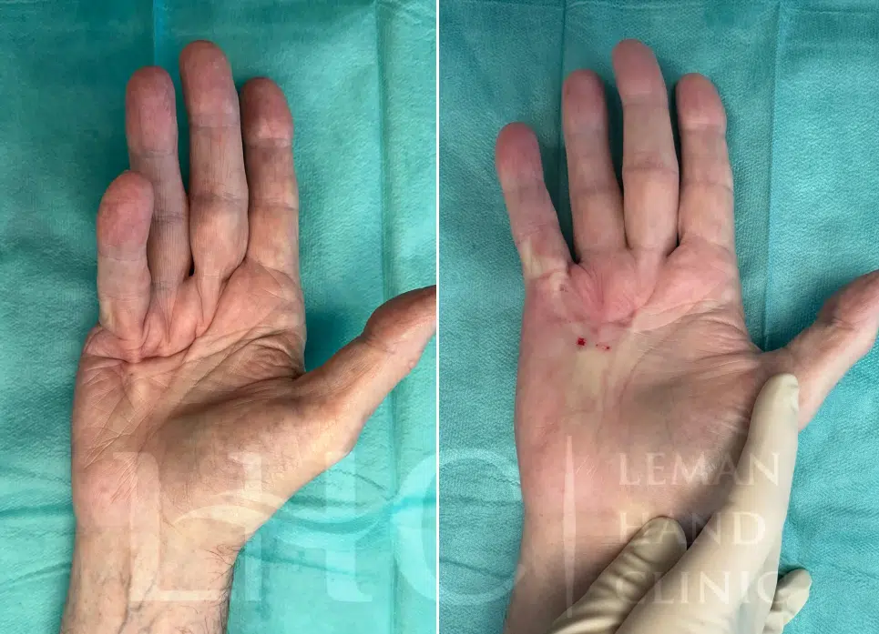 Photo d'une main avant/aprés une chirurgie dupuytren | Leman hand Clinic Genève