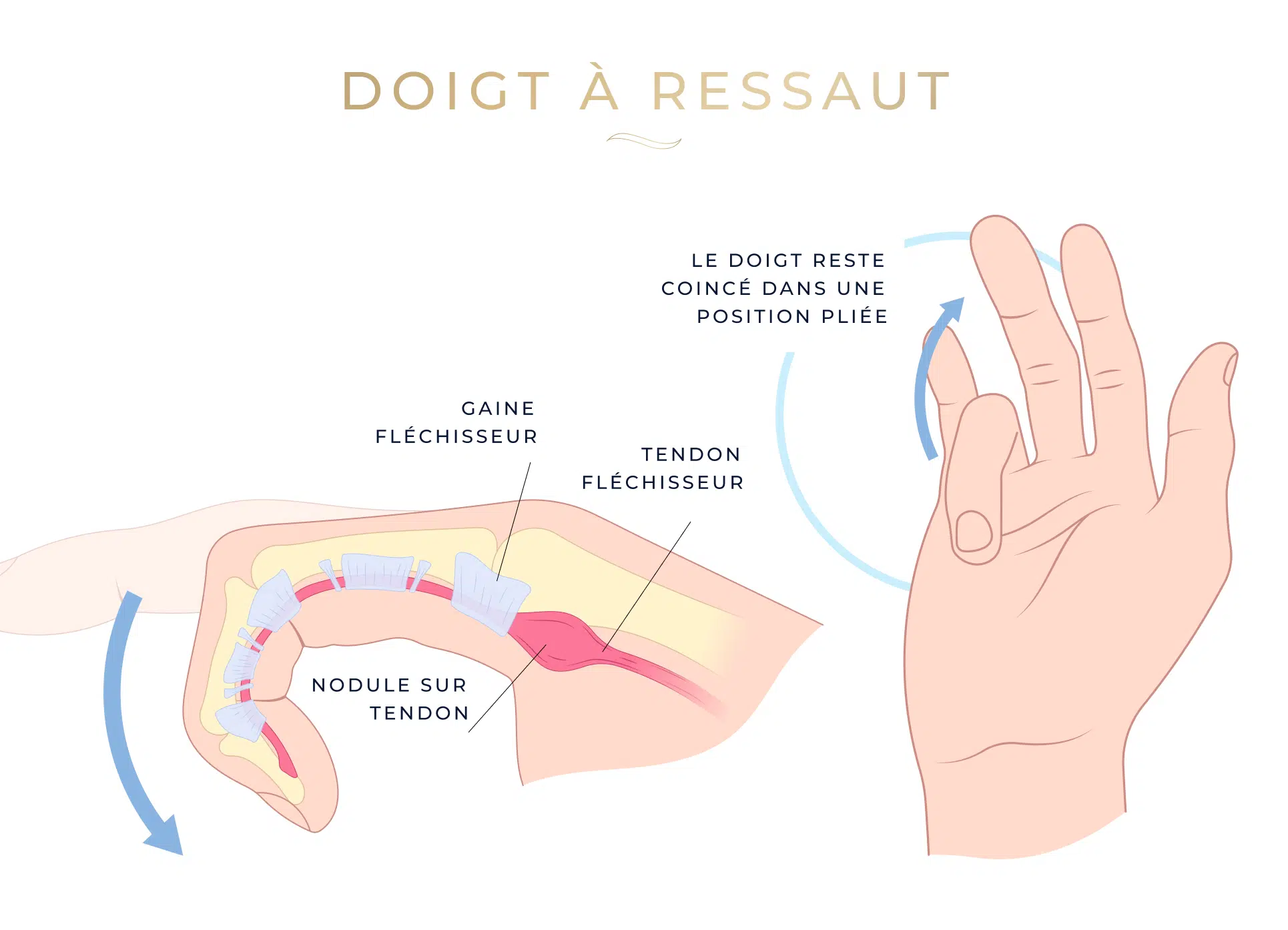 Dessin de la main montrant le cas du doigt à ressaut - Chirurgie doit à ressaut| Leman hand Clinic Genève