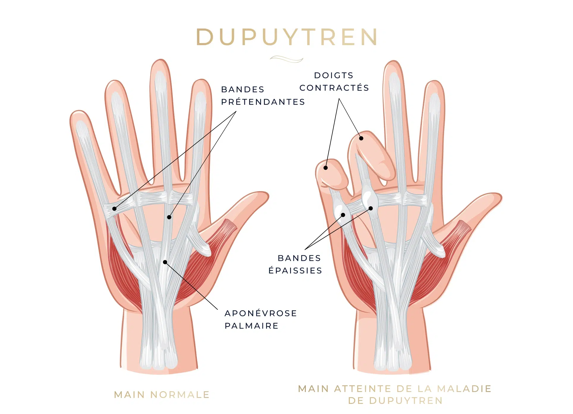 Image montrant une comparaison entre une main normale et une main atteinte de la maladie de Dupuytren | Leman hand Clinic Genève