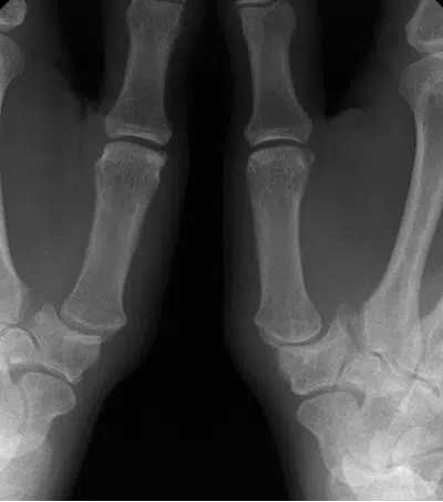 Radiographie des deux mains - Rhizathrose pathologie | Leman hand Clinic Genève