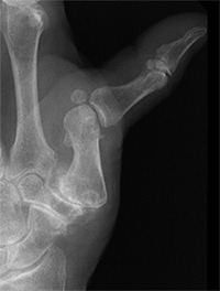Rhizarthrose, douleurs de pouce, pathologie fréquente de la main, arthrose du pouce, Clinique, Nyon, Suisse, Leman Hand Clinic, chirurgie de la main, chirurgien de la main